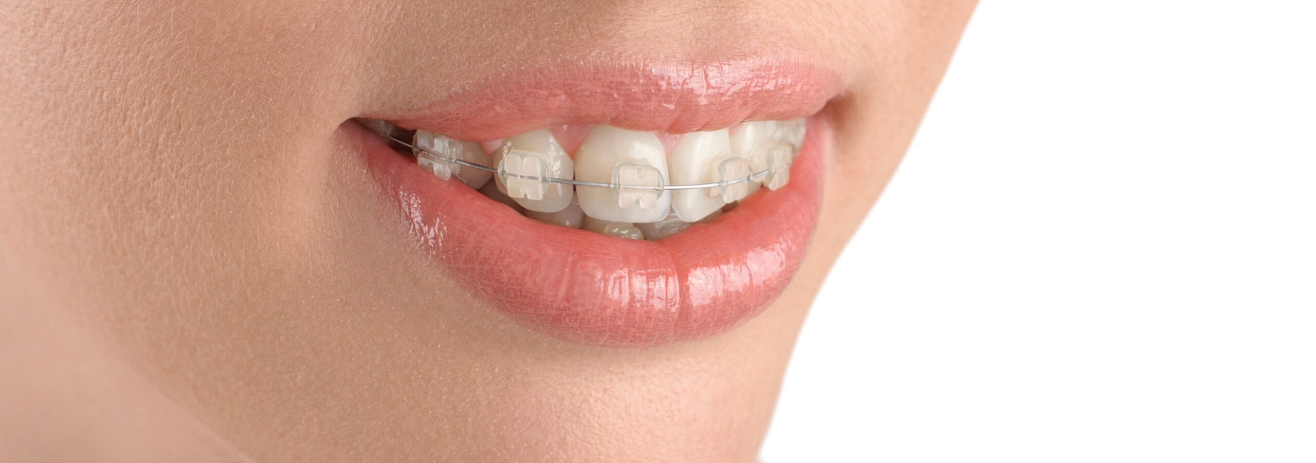 Symetri of traditional braces in Castle Pines, CO