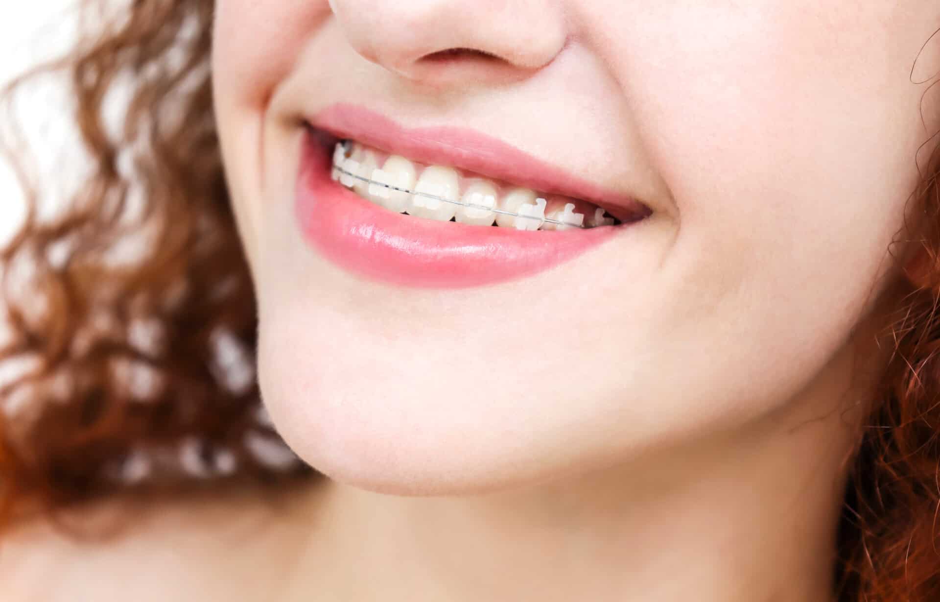 Girl in braces. Young european woman smiling in ceramic braces. Happy smile. Girl with curly red hair. Close up lips